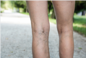varicose vein treatment Adelaide