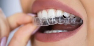 Invisalign Adelaide 