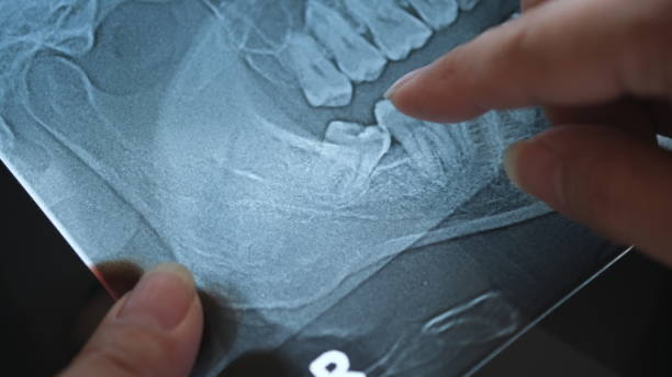 Wisdom Teeth Removal Adelaide